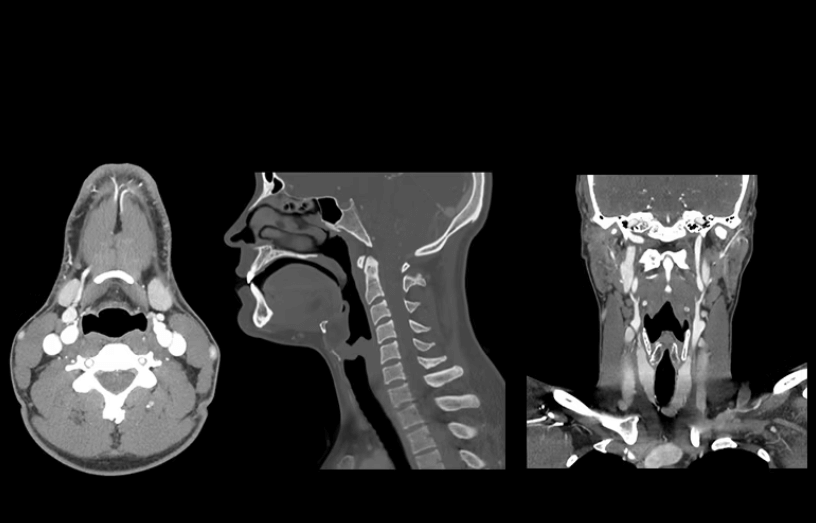 Tomografia de cuello