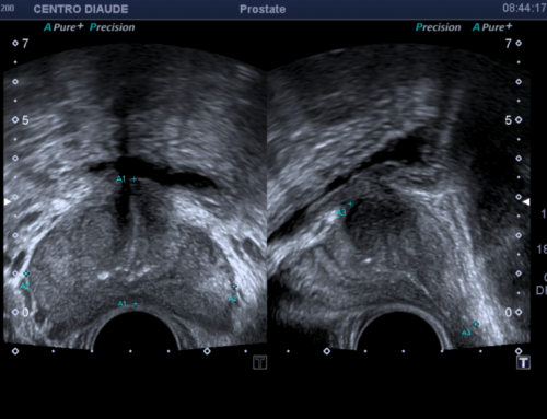 Ecografía Prostática y lo que deberías saber